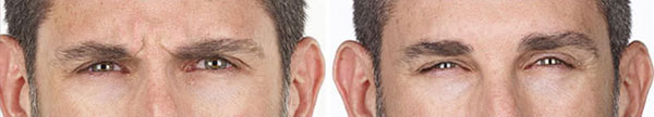 New-Leaf-Spa-Laser-Services-Injectables-Fillers-How-They-Work-Xeomin-fredbeforeafter-1-600x108
