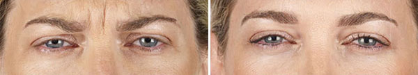 New-Leaf-Spa-Laser-Services-Injectables-Fillers-How-They-Work-Xeomin-tracybeforeafter-1-600x108