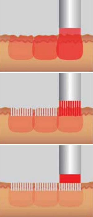 New-Leaf-Spa-Laser-Facials-Chemical-Peels-Fotona-SP-Dynamis-Laser-TwinLight-Fractional-Rejuvenation-Therapy-Steps-300x700