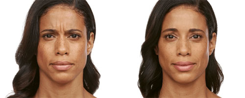 New-Leaf-Spa-Laser-Fillers-Jeuveau-amy-before-after-30-days-500x200