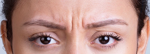 New-Leaf-Spa-Laser-Fillers-Xeomin-astrid-before-500x180
