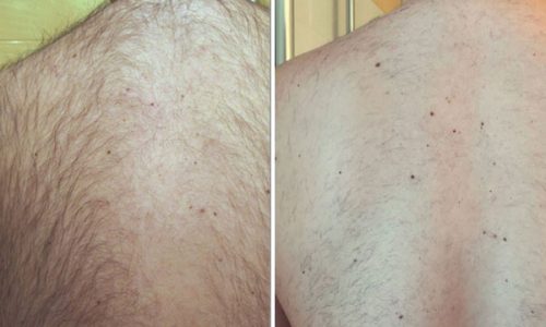 New-Leaf-Spa-Laser-Perfect-Time-Prepare-Summer-Laser-Hair-Removal-Blog-3-600x400 New-Leaf-Spa-Laser-Perfect-Time-Prepare-Summer-Laser-Hair-Removal-Blog-3-600x400