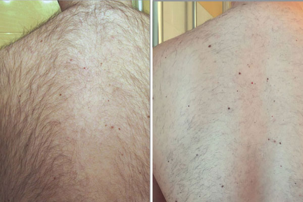 New-Leaf-Spa-Laser-Perfect-Time-Prepare-Summer-Laser-Hair-Removal-Blog-3-600x400