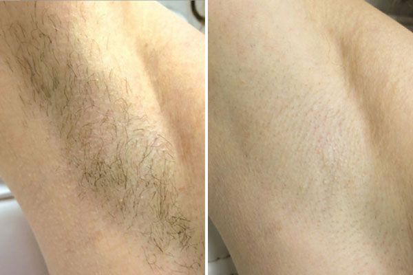 New-Leaf-Spa-Laser-Perfect-Time-Prepare-Summer-Laser-Hair-Removal-Blog-4-600x400