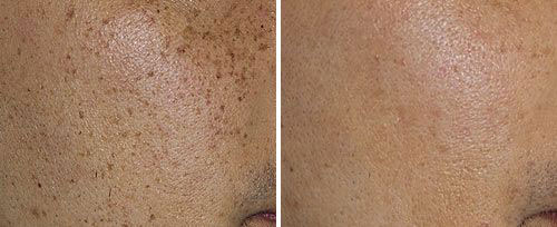 New-Leaf-Spa-Laser-Benign-Lesions-Treatment-Fotona-Laser-500x204