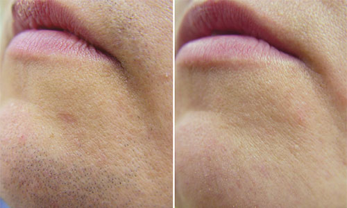 New-Leaf-Spa-Laser-Body-Treatments-Fotona-Laser-Hair-Removal-Chin-Before-After-500x300
