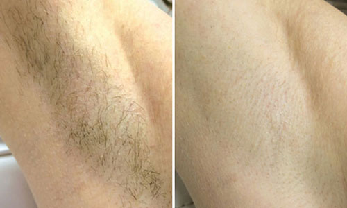 New-Leaf-Spa-Laser-Body-Treatments-Fotona-Laser-Hair-Removal-Underarm-Before-After-500x300