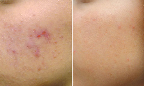 New-Leaf-Spa-Laser-Acne-Treatments-Before-After-1-500x300