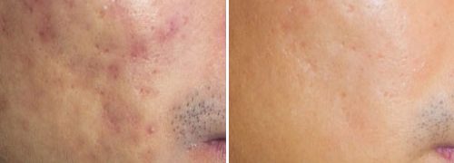 New-Leaf-Spa-Laser-Acne-Treatments-Before-After-2-500x300