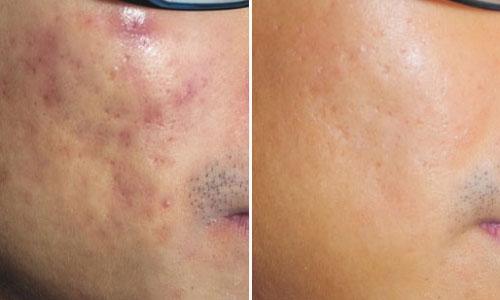 New-Leaf-Spa-Laser-Acne-Treatments-Before-After-2-500x300