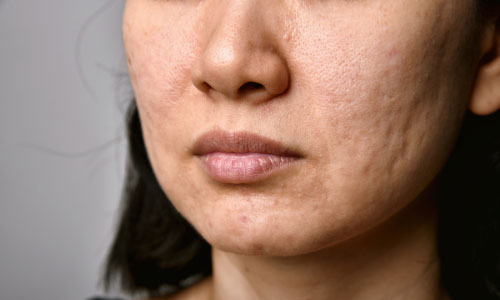 New-Leaf-Spa-Laser-Acne-Treatments-Scars-500x300