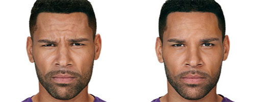 New-Leaf-Spa-Laser-Common-Types-Fillers-Botox-Levon-Before-After-7-Days-500x200