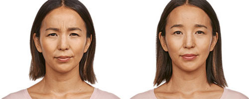 New-Leaf-Spa-Laser-Common-Types-Fillers-Jeuveau-Ann-Before-After-30-Days-500x200