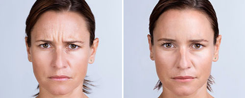 New-Leaf-Spa-Laser-Common-Types-Fillers-Xeomin-Anna-Before-After-14-Days-500x200