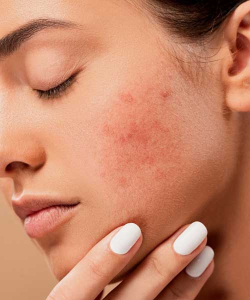 New-Leaf-Spa-Laser-Acne-Treatments-Laser-Topical-Effects-500x600
