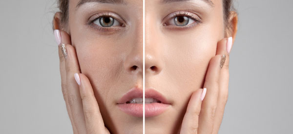 New-Leaf-Spa-Laser-Pore-Cleaning-What-Pores-Do-Blog-600x275