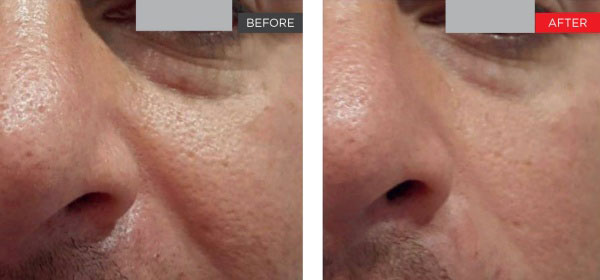 New-Leaf-Spa-Laser-Non-Surgical-Facelift-Fotona-SP-Dynamis-Before-After-600x280-3