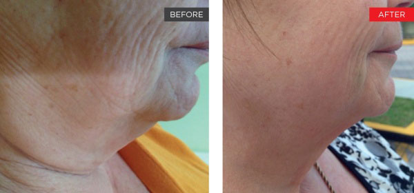New-Leaf-Spa-Laser-Non-Surgical-Facelift-Fotona-SP-Dynamis-Before-After-600x280-4