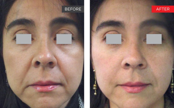 New-Leaf-Spa-Laser-Non-Surgical-Facelift-Fotona-SP-Dynamis-Before-After-600x373-6