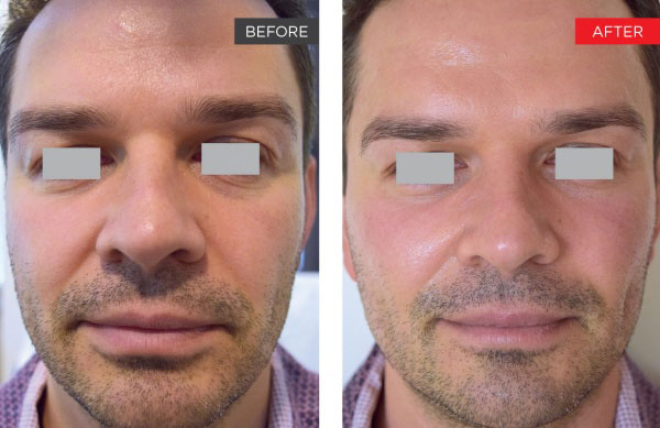 New-Leaf-Spa-Laser-Non-Surgical-Facelift-Fotona-SP-Dynamis-Before-After-600x389-1