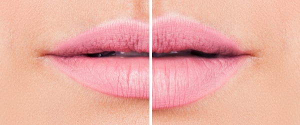 New-Leaf-Spa-Laser-Lip-Fillers-Injection-Services-3-600x250