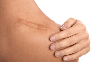 Depending on the severity of the scarring, laser treatments can reduce the appearance of scars.